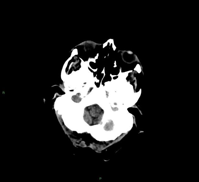 File:Cerebral amyloid angiopathy-associated lobar intracerebral hemorrhage (Radiopaedia 58377-65514 Axial non-contrast 42).jpg