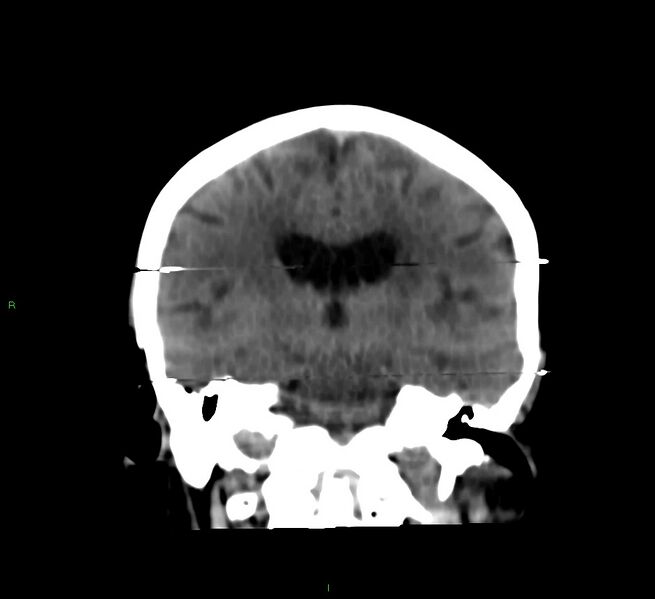 File:Cerebral amyloid angiopathy-associated lobar intracerebral hemorrhage (Radiopaedia 58377-65514 Coronal non-contrast 32).jpg