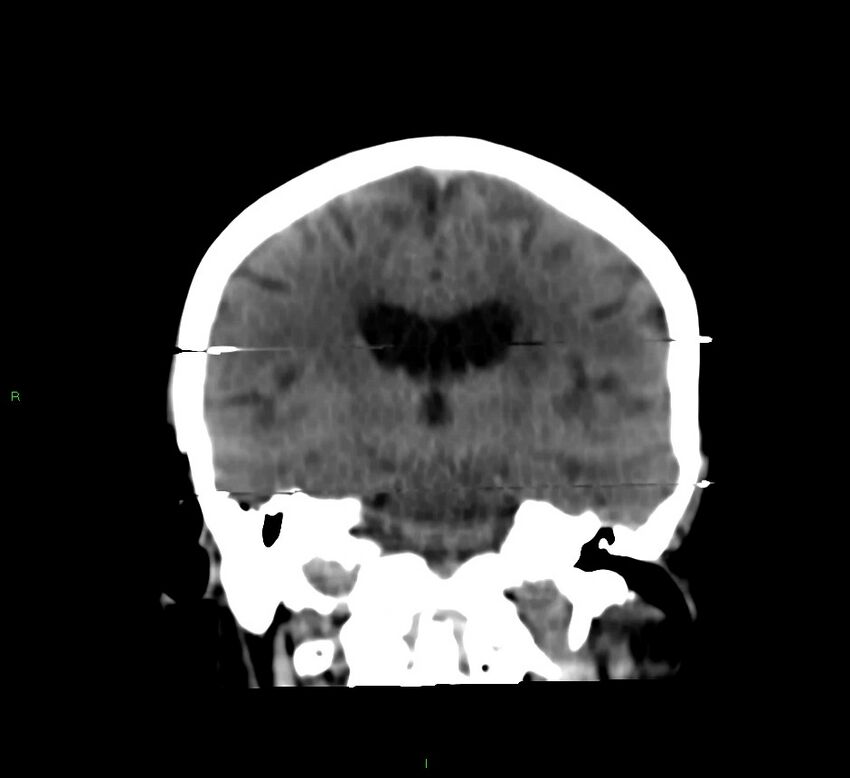 Cerebral amyloid angiopathy-associated lobar intracerebral hemorrhage (Radiopaedia 58377-65514 Coronal non-contrast 32).jpg