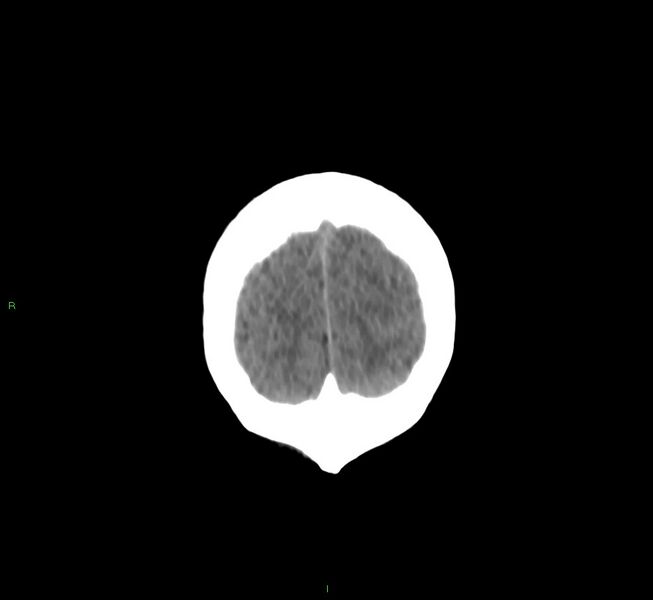 File:Cerebral amyloid angiopathy-associated lobar intracerebral hemorrhage (Radiopaedia 58530-65688 Coronal non-contrast 9).jpg