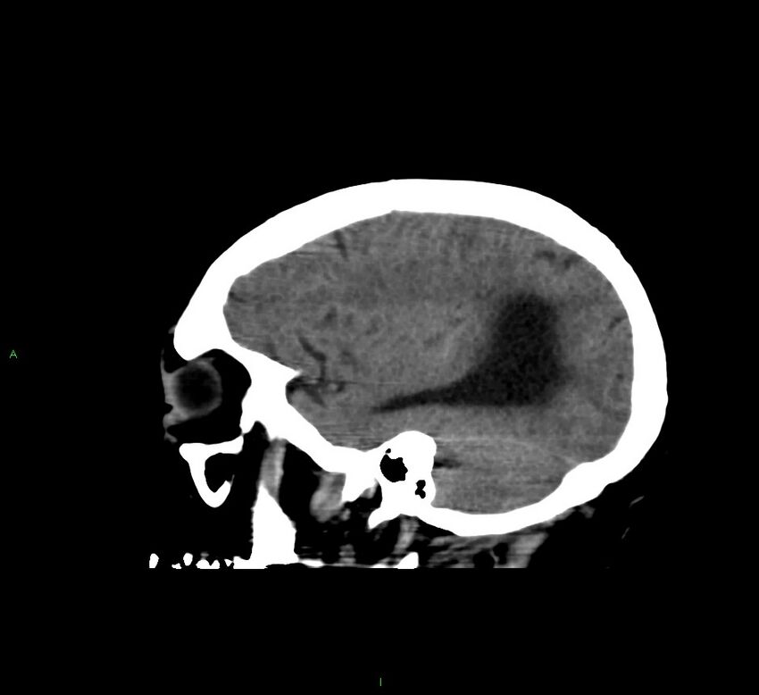 Cerebral amyloid angiopathy-associated lobar intracerebral hemorrhage (Radiopaedia 58560-65723 C 39).jpg