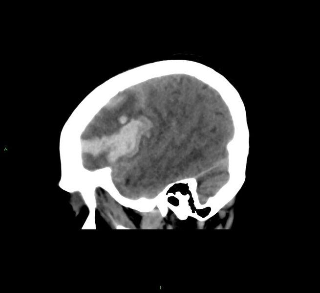 File:Cerebral amyloid angiopathy-associated lobar intracerebral hemorrhage (Radiopaedia 58561-65724 C 40).jpg
