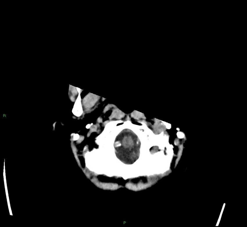 Cerebral amyloid angiopathy-associated lobar intracerebral hemorrhage (Radiopaedia 58563-65727 Axial non-contrast 49).jpg