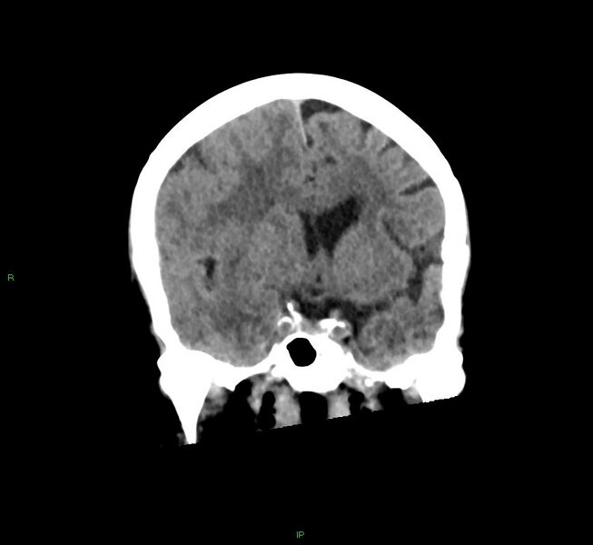 File:Cerebral amyloid angiopathy-associated lobar intracerebral hemorrhage (Radiopaedia 58563-65727 Coronal non-contrast 41).jpg