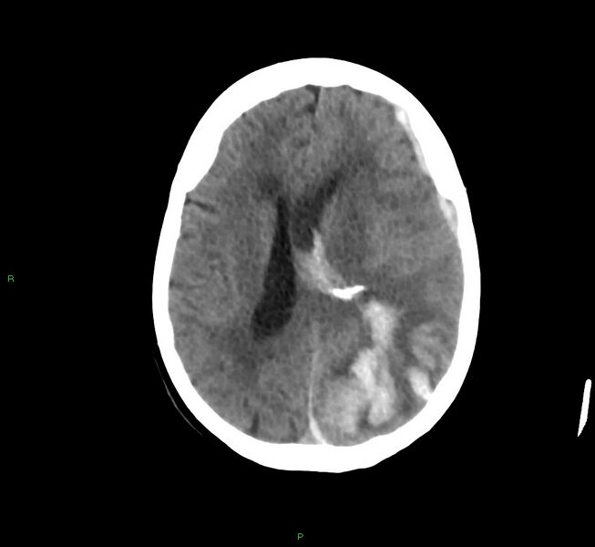 File:Cerebral amyloid angiopathy-associated lobar intracerebral hemorrhage (Radiopaedia 58754-65975 Axial non-contrast 29).jpg