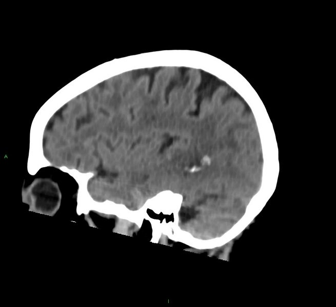 File:Cerebral amyloid angiopathy-associated lobar intracerebral hemorrhage (Radiopaedia 58757-65978 C 16).jpg