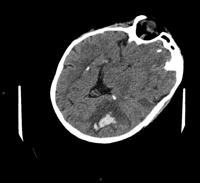 File:Cerebral amyloid angiopathy-associated lobar intracerebral hemorrhage (Radiopaedia 58757-65979 Axial non-contrast 46).jpg