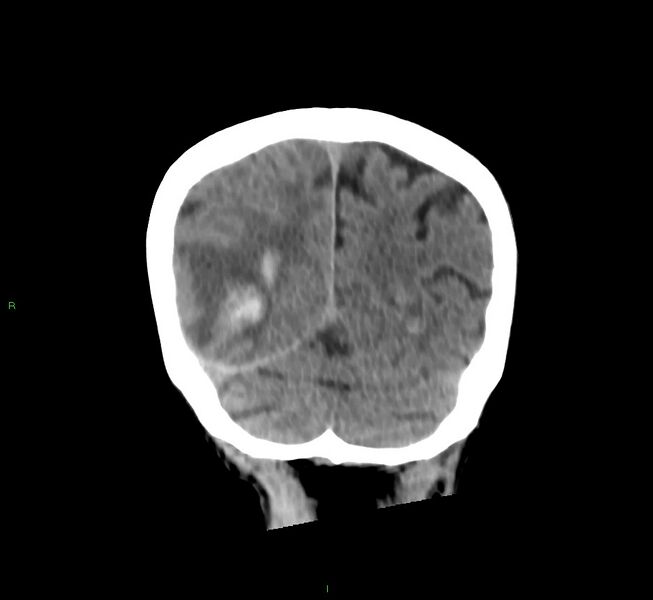 File:Cerebral amyloid angiopathy-associated lobar intracerebral hemorrhage (Radiopaedia 58758-65980 Coronal non-contrast 17).jpg