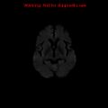 Cerebral and orbital tuberculomas (Radiopaedia 13308-13311 Axial DWI 10).jpg