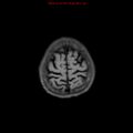 Cerebral and orbital tuberculomas (Radiopaedia 13308-13311 Axial T1 19).jpg
