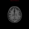 Cerebral and orbital tuberculomas (Radiopaedia 13308-13311 Axial T1 C+ 15).jpg