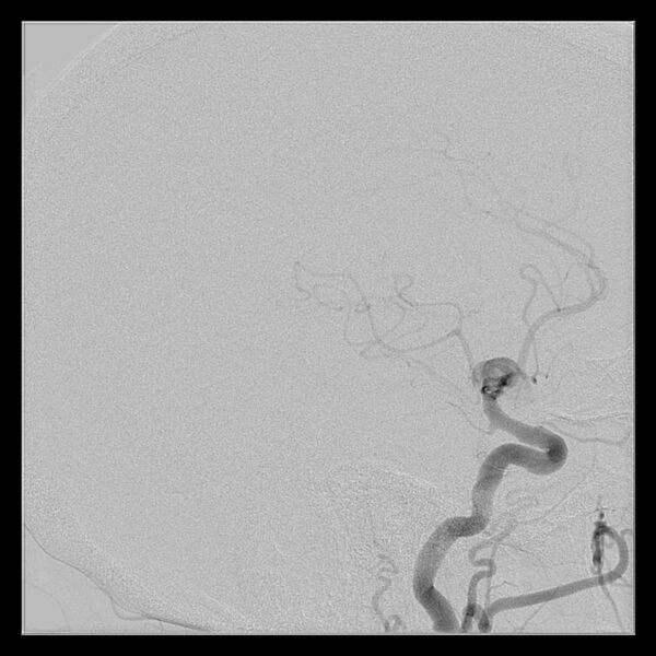 File:Cerebral aneurysm with rupture (Radiopaedia 29933-30458 LT ICA IC 39).jpg