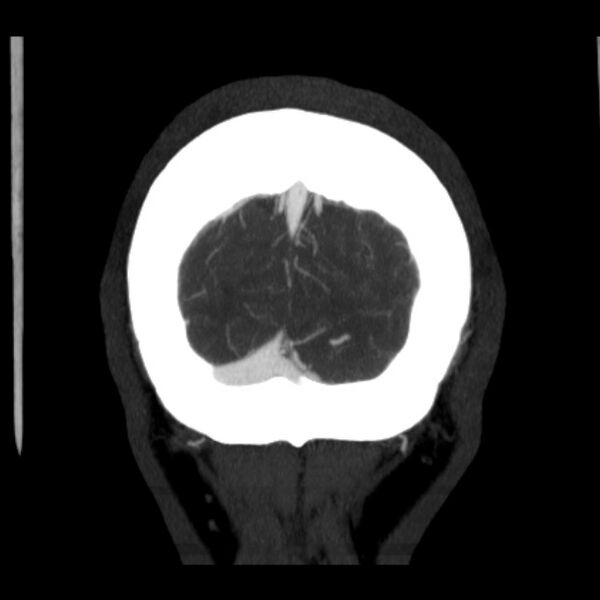File:Cerebral arteriovenous malformation (Radiopaedia 43729-47189 C 45).jpg