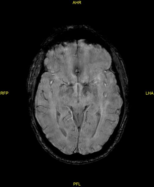 File:Cerebral autosomal dominant arteriopathy with subcortical infarcts and leukoencephalopathy (CADASIL) (Radiopaedia 86108-102054 Axial SWI 51).jpg