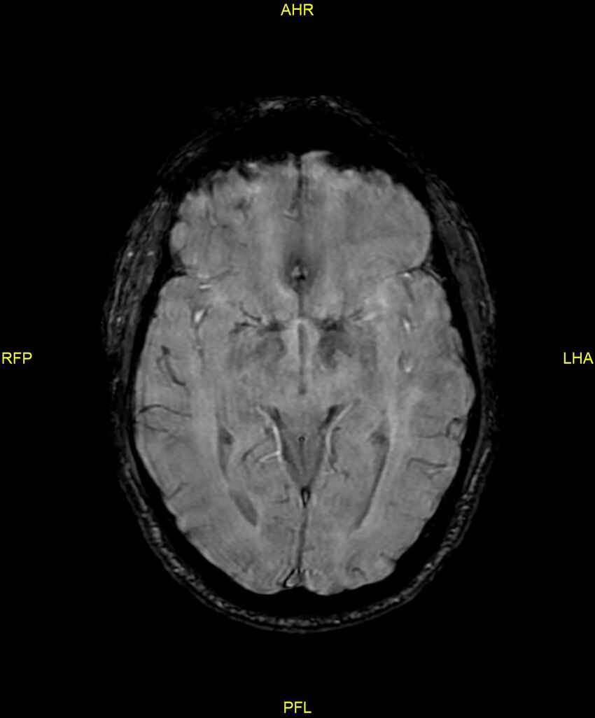 Cerebral autosomal dominant arteriopathy with subcortical infarcts and leukoencephalopathy (CADASIL) (Radiopaedia 86108-102054 Axial SWI 51).jpg