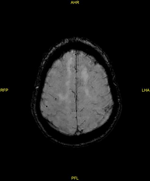 File:Cerebral autosomal dominant arteriopathy with subcortical infarcts and leukoencephalopathy (CADASIL) (Radiopaedia 86108-102054 Axial SWI 86).jpg