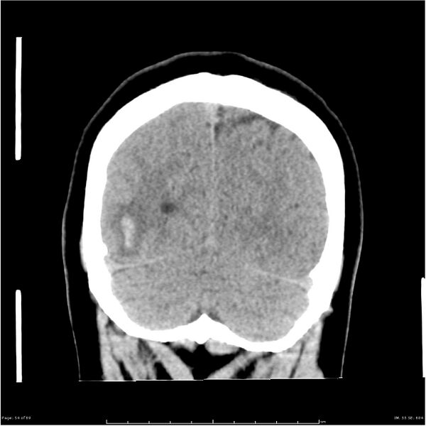 File:Cerebral hemorrhage secondary to arteriovenous malformation (Radiopaedia 33497-34561 Coronal non-contrast 45).jpg