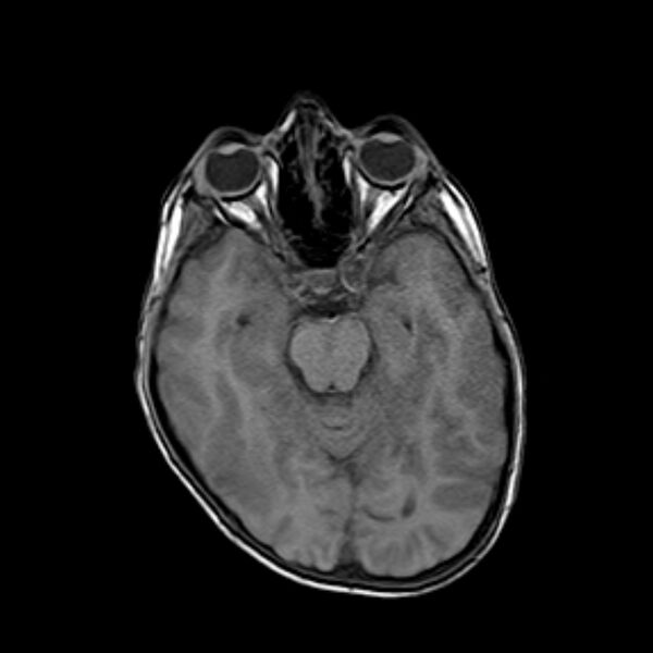 File:Cerebral tuberculoma (Radiopaedia 41152-43932 Axial T1 8).jpg