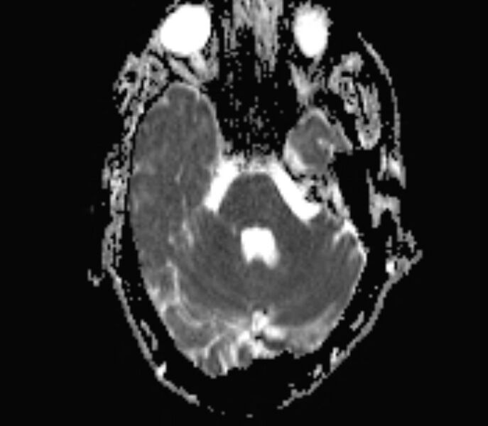 File:Cerebral venous thrombosis (Radiopaedia 71207-81504 Axial ADC 5).jpg