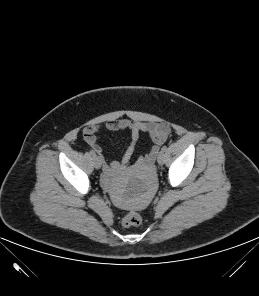 File:Cervical aortic arch with coarctation and aneurysms (Radiopaedia 44035-47552 Axial non-contrast 88).jpg