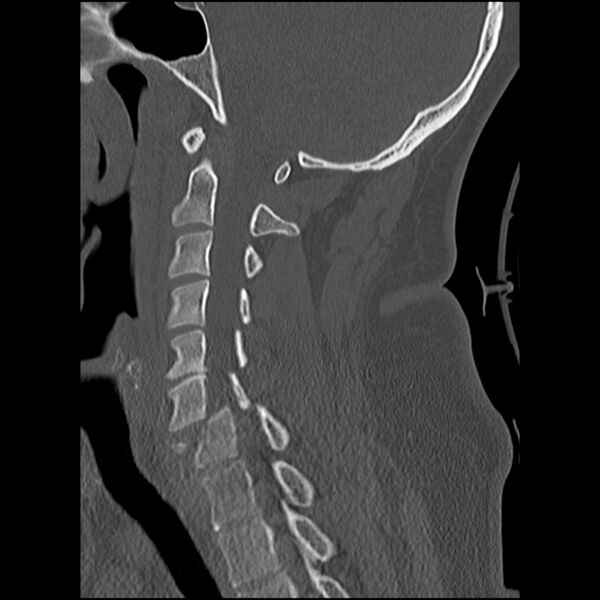 File:Cervical fracture and dislocation with locked facet (Radiopaedia 31837-32780 Sagittal bone window 13).jpg