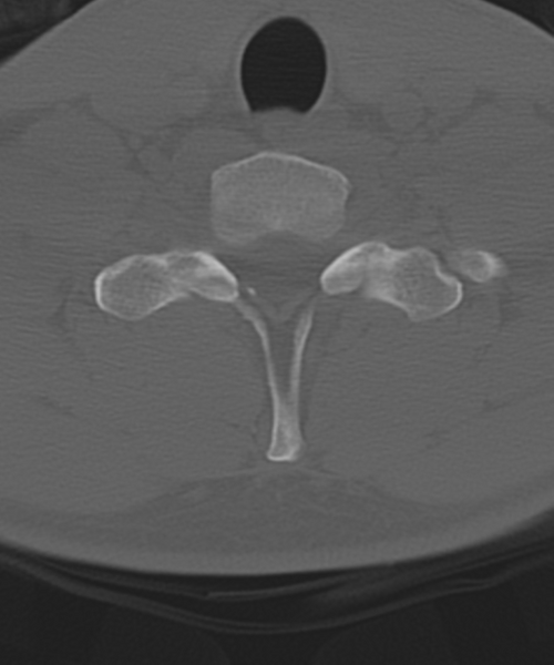 File:Cervical intercalary bone (Radiopaedia 35211-36748 Axial bone window 54).png