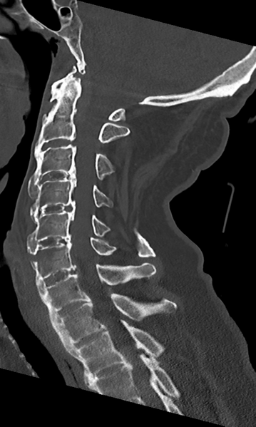 File:Cervical spine fracture - chalk stick (Radiopaedia 39116-41323 Sagittal bone window 31).png