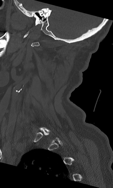 File:Cervical spine fracture - chalk stick (Radiopaedia 39116-41323 Sagittal bone window 49).png