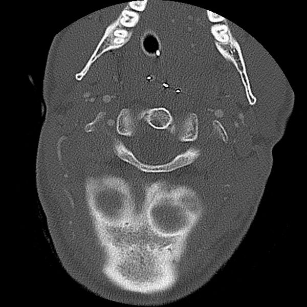 File:Cervical spine fractures with vertebral artery dissection (Radiopaedia 32135-33078 Axial bone window 65).jpg