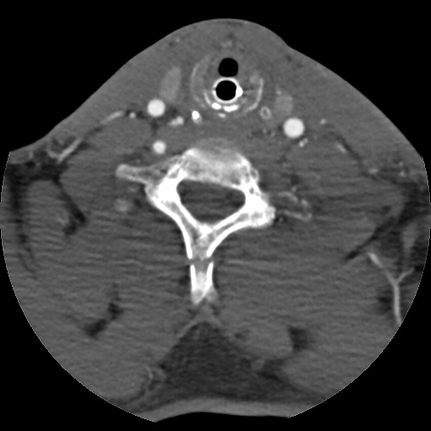 Cervical spine fractures with vertebral artery dissection (Radiopaedia 32135-33078 D 30).jpg