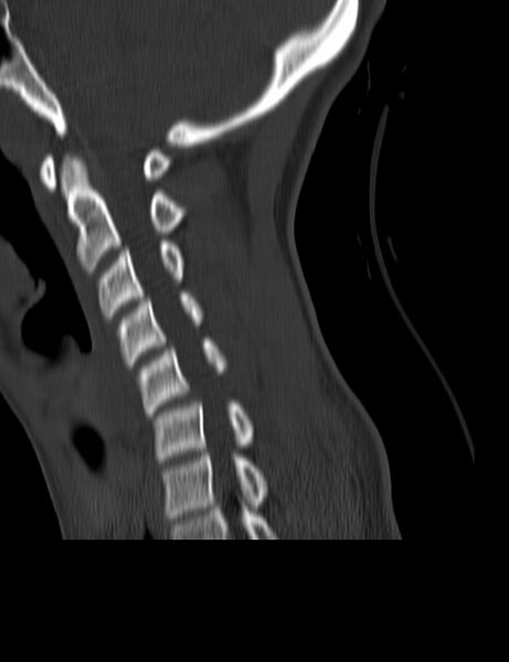 File:Cervical spine posterior ligamentous complex rupture (Radiopaedia 63486-72101 Sagittal bone window 15).jpg