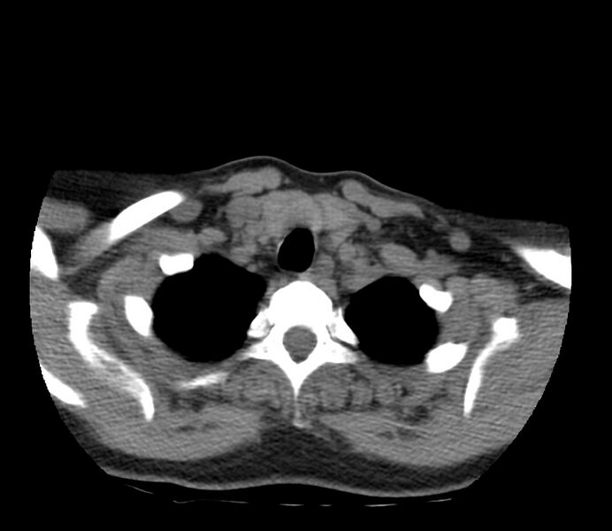 File:Cervical venous malformation (Radiopaedia 22653-22672 Axial non-contrast 49).jpg
