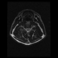 Cervical vertebrae metastasis (Radiopaedia 78814-91667 Axial T2 11).png