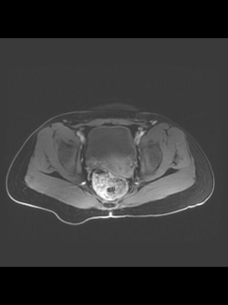 File:Cesarean section scar endometrioma (Radiopaedia 56569-63297 Axial T1 C+ fat sat 15).jpg