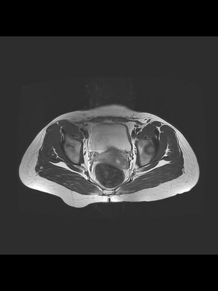 File:Cesarean section scar endometrioma (Radiopaedia 56569-63297 Axial T2 18).jpg