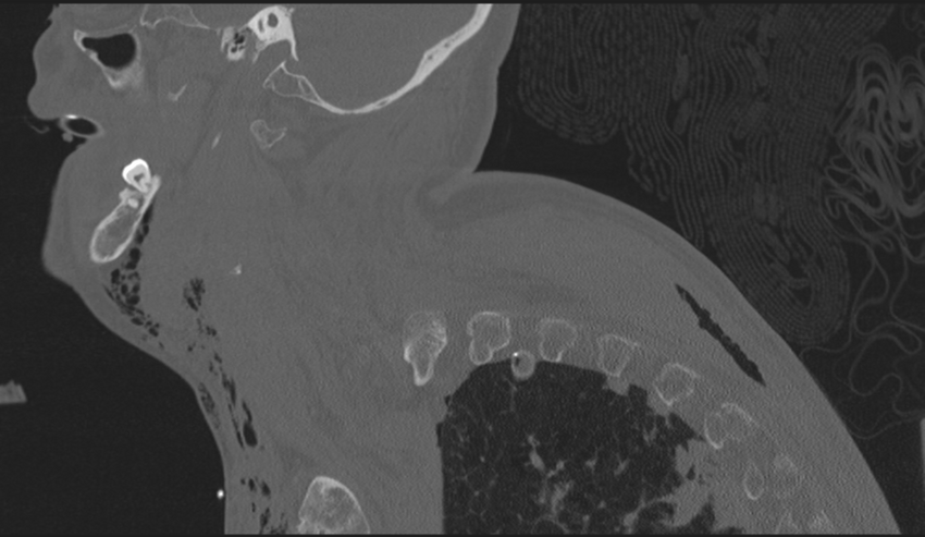 Chalk stick fracture (Radiopaedia 57948-64928 Sagittal bone window 56).png