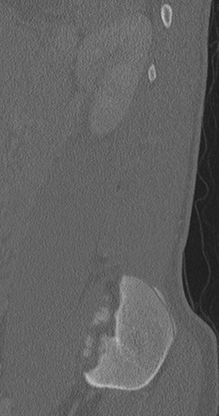 File:Chance fracture (Radiopaedia 40360-42912 Sagittal bone window 18).png