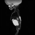 Chiari II malformation with spinal meningomyelocele (Radiopaedia 23550-23652 Sagittal T2 9).jpg