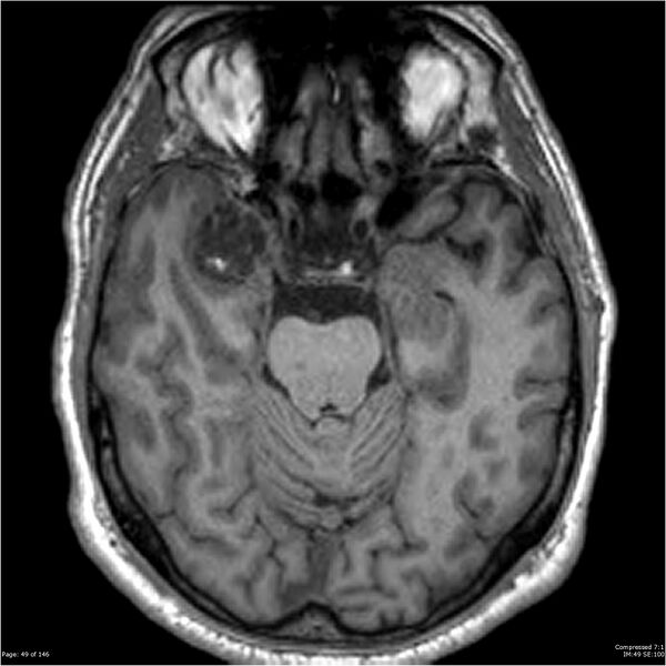 File:Chondrosarcoma of skull base- grade II (Radiopaedia 40948-43654 Axial T1 49).jpg