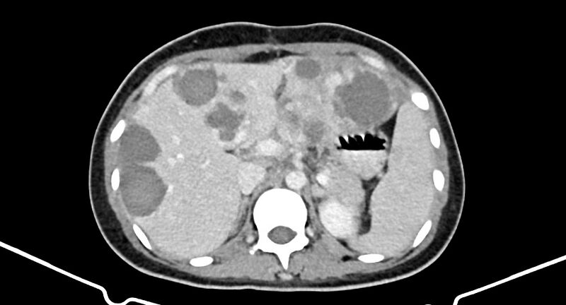 File:Choriocarcinoma liver metastases (Radiopaedia 74768-85766 A 70).jpg