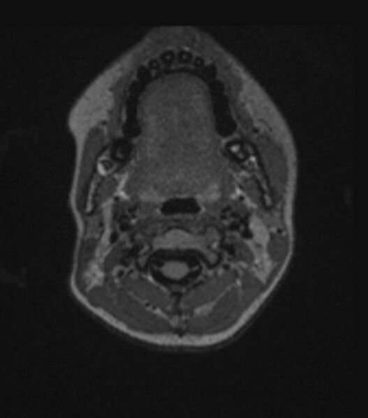 File:Choroid plexus carcinoma (Radiopaedia 91013-108553 Axial FLAIR C+ 42).jpg