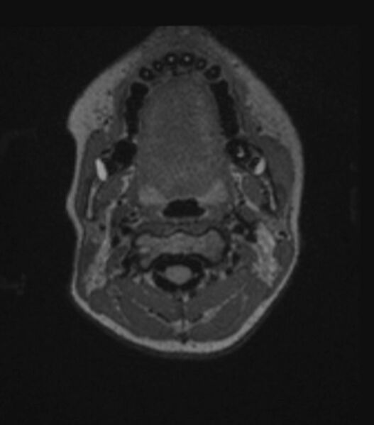 File:Choroid plexus carcinoma (Radiopaedia 91013-108553 Axial FLAIR C+ 44).jpg