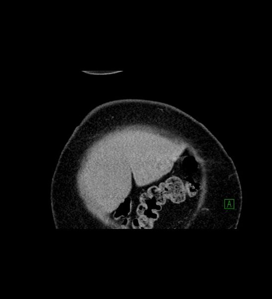 File:Chromophobe renal cell carcinoma (Radiopaedia 84239-99519 C 7).jpg