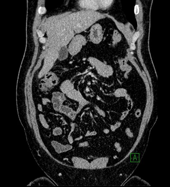 File:Chromophobe renal cell carcinoma (Radiopaedia 84286-99573 H 51).jpg