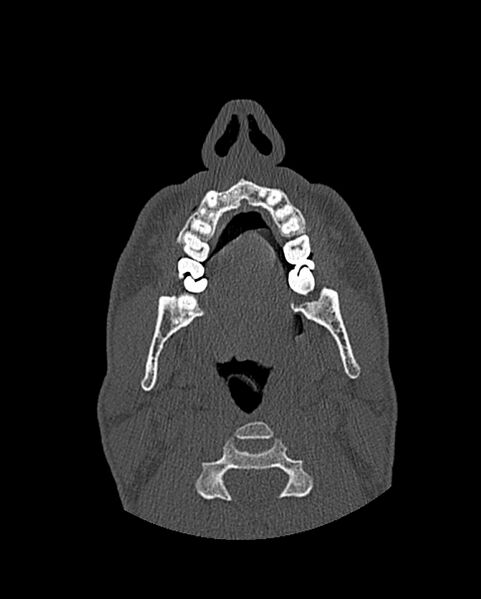 File:Chronic maxillary sinusitis caused by a foreign body (Radiopaedia 58521-65676 Axial bone window 10).jpg