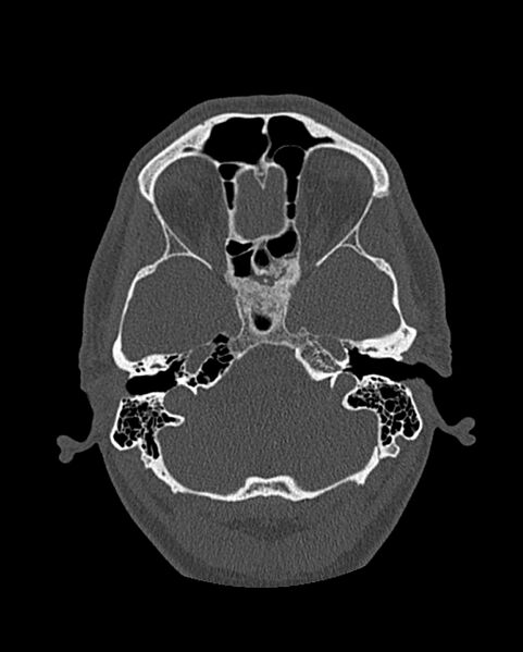 File:Chronic maxillary sinusitis caused by a foreign body (Radiopaedia 58521-65676 Axial bone window 233).jpg