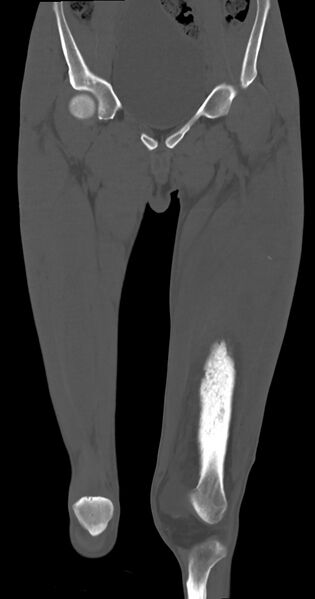 File:Chronic osteomyelitis (with sequestrum) (Radiopaedia 74813-85822 Coronal non-contrast 18).jpg