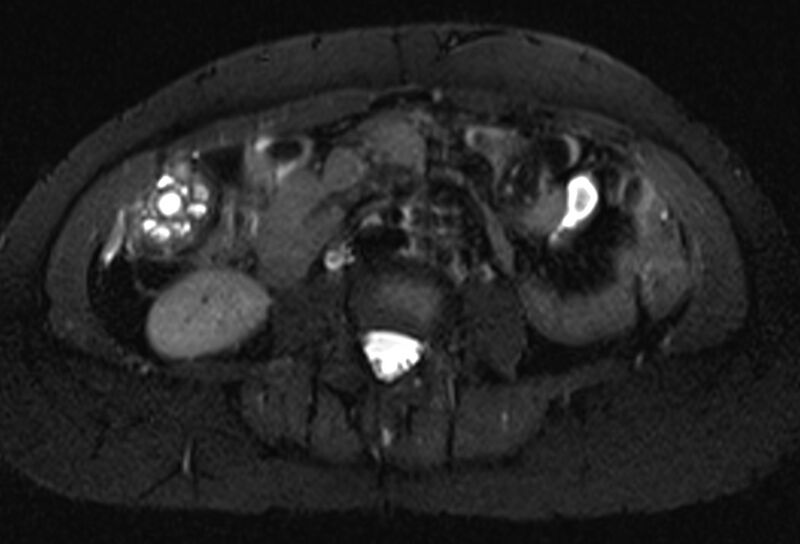 File:Chronic pancreatitis - pancreatic duct calculi (Radiopaedia 71818-82250 Axial T2 fat sat 45).jpg