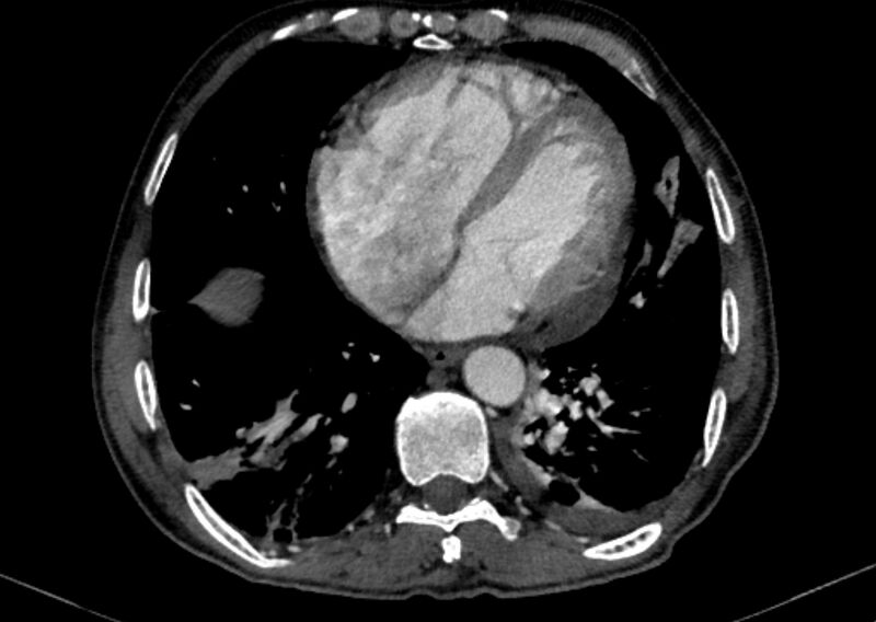 File:Chronic pulmonary embolism with bubbly consolidation (Radiopaedia 91248-108850 C+ arterial phase 107).jpg