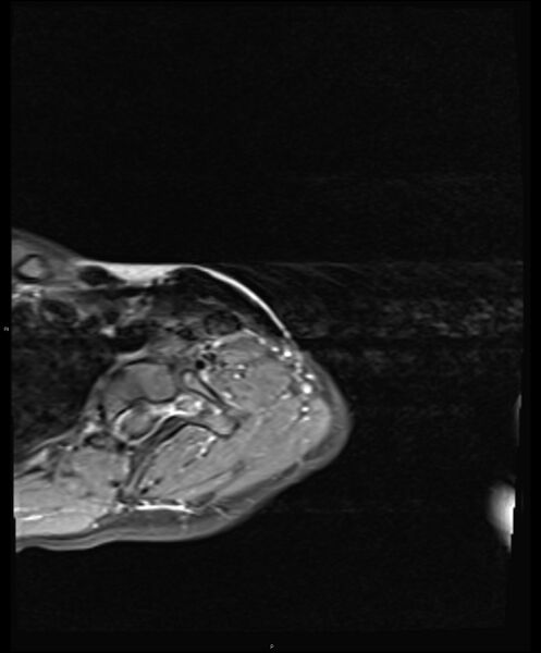 File:Chronic reactive multifocal osteomyelitis (CRMO) - clavicle (Radiopaedia 56406-63114 Axial T1 C+ fat sat 2).jpg